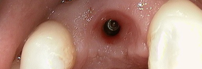IMPLANTATE in Kleefeld