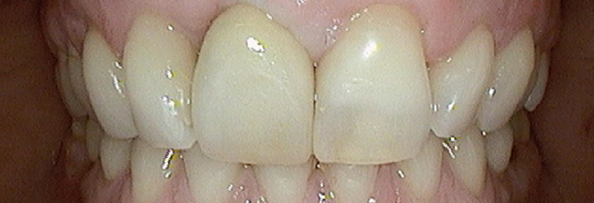 IMPLANTATE in Kleefeld