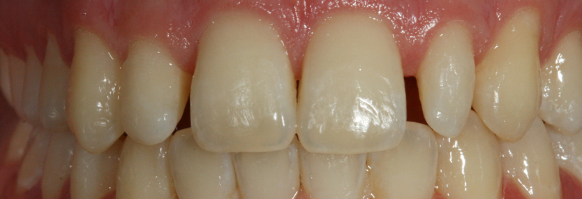 Minimal- und noninvasive Kariestherapie